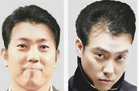 모발이식에 대한 궁금증, 건강 365에서 풀어드립니. ì€ì§€ì› íƒˆëª¨ìœ„í—˜ ê°€ìƒ ëŒ€ë¨¸ë¦¬ ì‚¬ì§„ ëˆˆê¸¸
