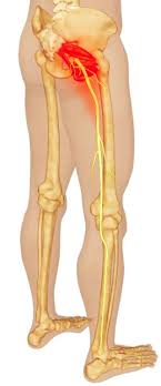 Piriformis Syndrome Back In Action