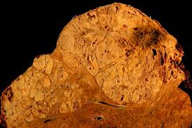 Certain chemicals that cause liver cancer, such as aflatoxins, are known to damage the dna in liver cells. Hepatocellular Carcinoma Wikipedia