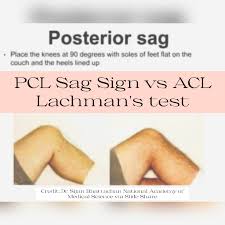 Image result for PCL Sulcus Test
