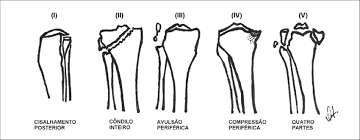 Classifications ensure health data is consistent, and enable governments, researchers, and the health care sector to exchange health data with each other. Classificacao De Hohl E Moore Detalhe Do Tipo I Que Corresponde As Download Scientific Diagram