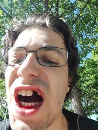 Dear friends, My name is Lkhagva-Ochir, a father of three from Mongolia.  Eight months ago, a motorcycle accident shattered my lower leg, and part of  my shinbone was lost. I have undergone