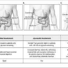 Take action now for maximum saving as these. Types Of Intestinal Resections A Jejunoileal Anastomosis B Download Scientific Diagram