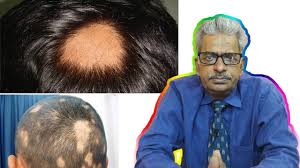 Homeopathy medicines for hair loss treat the root cause of hair loss and promote hair growth. Alopecia Areata Discussion And Treatment In Homeopathy By Dr P S Tiwari Youtube