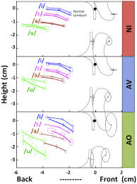 Speech modification's smart app is american accent training at your fingertips. Modification Of The Tongue Position Between Normal Speech Dotted Download Scientific Diagram