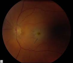 Pin On Neuro Ophthalmology