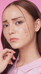 Kadang suka hopeless, ngeliat kondisi muka yang gak kunjung membaik.  Katanya breakout bisa muncul karena stress, tapi pas udah muncul juga jadi  makin stress. Bener gak? , Meskipun jerawat itu normal, ...