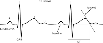 Image result for QT Interval