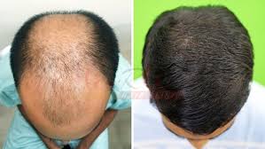 Hair transplant surgery does not stop continued hair thinning and hair loss. Is Transplantation Of Hair Permanent Quora