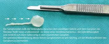 Ganglion Uberbein Zentrum Fur Handchirurgie Nurnberg
