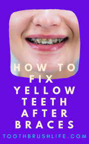 Teeth Yellow After Braces Why And How To Fix It Toothbrush Life After Braces Teeth After Braces Yellow Teeth