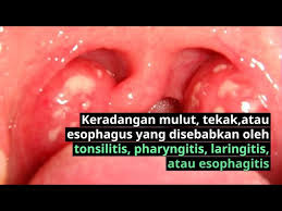 Anak saya mempunyai 8 tahun lebih daripada 34 hari. Sakit Tekak Ketika Menelan Odynophagia Punca Rawatan Doctoroncall