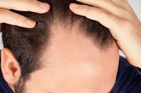 Hair Loss on Temples: Symptoms, Causes & Effective Treatment