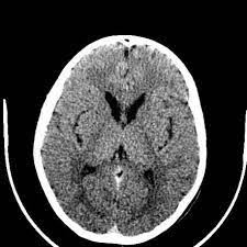 Huntington Disease Radiology Reference Article Radiopaedia Org