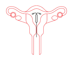 Sometimes an appointment for a pelvic exam, where you discuss whether the iud is right for you, is required before the insertion appointment can be made. What S An Iud Insertion Like