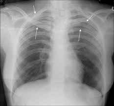 It encloses and protects the heart and lungs. Chest X Ray Showing Crowding Of Ribs Arrows Download Scientific Diagram