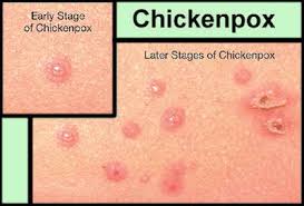 Infeksi bakteri tbc selain bercirikan batuk yang tak kunjung sembuh, juga warna dahak kemerahan. Cara Merawat Chicken Pox Cacar Air Bayi