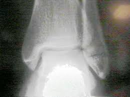 The trauma is sometimes accompanied by ligament damage and dislocation. Ao Weber Type A Malleolar Fractures Wheeless Textbook Of Orthopaedics