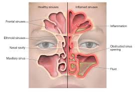 Sinus Infection Sinusitis Community Antibiotic Use Cdc