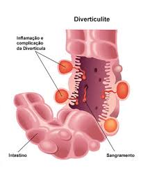 3 proposed a classification for acute diverticulitis, (anywhere along the bowel, not just the colon) that has been variously adapted, and is useful not only in academia but also. Diverticulite Aguda Grupo Surgical