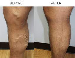 Varicose Veins Laser Treatment Peter Brukasz Md Addison Il Palos Hills Il