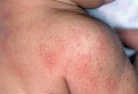 Baby Skin Care Simple Tips To Keep Baby S Skin Healthy Slideshow Baby Rash Heat Rash Prickly Heat Rash