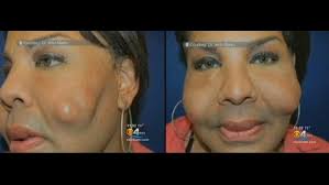 Butt Boosting 'Doc' Gave Woman Chipmunk Cheeks