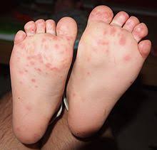 To assess the views of paediatric specialist dental practitioners in the united kingdom of the use of the hand over mouth technique and physical restraint. Hand Foot And Mouth Disease Wikipedia