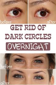 Get Rid Of Dark Circles Under Your Eyes Overnight Own Kind Of Beauty In 2020 Dark Eye Circles Dark Circles Around Eyes Dark Circles Under Eyes