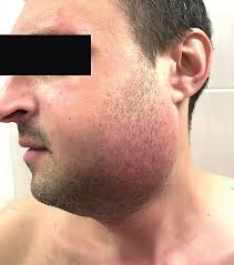 Image result for phlegmon on face)