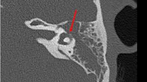 Image result for Bacterial Labyrinthitis