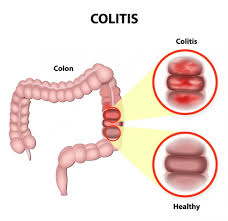 Inflammatory Bowel Disease Ulcerative Colitis And Crohn S Disease