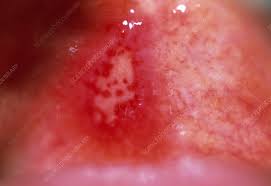 Image result for Mouth ulcers symptoms roof of the mouth