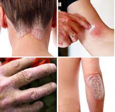 Psoriasis Warum Schuppenflechte Mehr Als Ein Hautproblem Ist Welt