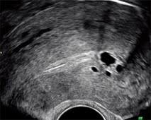 L'adénomyose ou endométriose interne est une maladie utérine fréquente et bénigne. Endometriose Et Fertilite