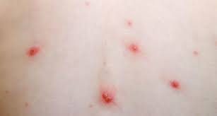 3 أسئلة وإجاباتها عن الجدري المائي