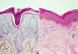 Increased Mortality In Connective Tissue Diseases Primary Systemic Vasculitides Rheumatology Advisor