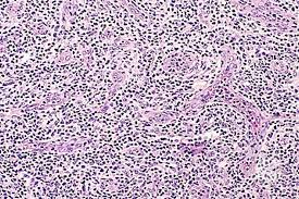 (pathology) relating to, or characterised by immunoblasts of lymph glands. Angioimmunoblastic T Cell Lymphoma 5
