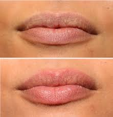 Comment repulper ses lèvres sans injections ? Restaurer Les Levres Avec Les Injections D Acide Hyaluronique Ou Le Laser