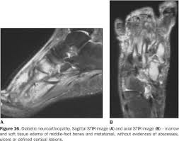 The extrinsic muscles are located in the anterior and lateral compartments of the leg. Scielo Brasil Metatarsalgias Diagnostico Diferencial Por Meio Da Ressonancia Magnetica Metatarsalgias Diagnostico Diferencial Por Meio Da Ressonancia Magnetica