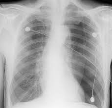 Normally, the outer surface of the lung sits next to the inner surface of . Spontanpneumothorax Deximed