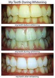 I've used crest whitestrips a few times, and each time was impressed at just how well they whitened my teeth. Crest 3d Whitestrips Professional Effects Review