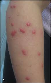 Image result for bedbugs bites
