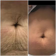 She said it's perfectly fine to take pain relievers after vaccination. Fat Burner Injections Lipotropic Injections Genesys Medical Plzen