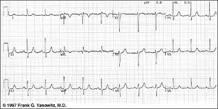 The ecg findings of a pathologic q. Ecg Learning Center Test