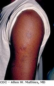 The herpes simplex virus can also cause a skin rash anywhere on the body. Viral Skin Infection Herpes Gladiatorum Mat Herpes