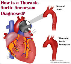 How Is A Thoracic Aortic Aneurysm Diagnosed Aortic Aneurysm Aneurysm Thoracic Update on the diagnosis and management of popliteal aneurysm and literature review.