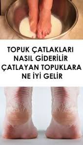 Topuk Catlaklari Nasil Giderilir Catlayan Topuklara Ne Iyi Gelir Saglikli Yasam Tarzi Evde Hazirlabilen Ilaclar Dogal Cilt