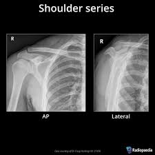 Image result for Shoulder XRay