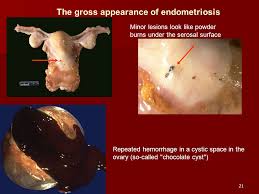 After years of irregular periods and pelvic pain, she underwent a laparoscopy and was diagnosed with endometriosis in december. Lecture On Pathomorphology For The 3 Rd Year Students Ppt Download